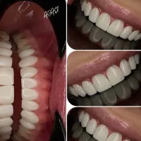 ایمپلنت و کامپوزیت دندان فقط از 10|خدمات آرایشگری و زیبایی|نورآباد, |دیوار