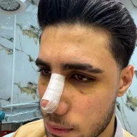 لیفت شقیقه توسط متخصص چشم تخفیف ویژه سه نفر اول|خدمات آرایشگری و زیبایی|تهران, تجریش|دیوار