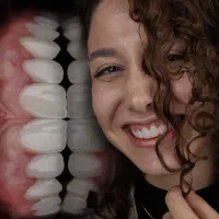 ایمپلنت کامپوزیت لمینت روکش ترمیم