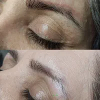 ریمو تتو ،پاک‌کردن تتو با لیزر تخصصی