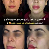 نیاز فوری به مانکن جهت تزریق بوتاکس و فیلر لب|خدمات آرایشگری و زیبایی|تهران, امانیه|دیوار