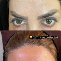 تزریق بوتاکس کل صورت و زیر بغل|خدمات آرایشگری و زیبایی|کرمانشاه, |دیوار
