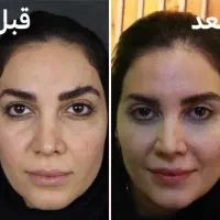 لیپو/ابدو/بلفارو/کاشت/ قسطی در تهران|خدمات آرایشگری و زیبایی|زاهدان, |دیوار