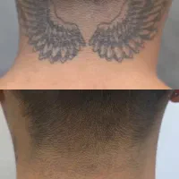 پاک کردن تتو با کیوسوئیچ2026