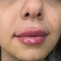 ژل و بوتاکس|خدمات آرایشگری و زیبایی|بجنورد, |دیوار