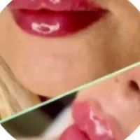 تخفیف ویژه تزریق بوتاکس و ژل باکادر مجرب