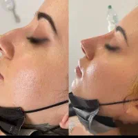 برداشتن خال و زگیل.جوانسازی.بوتاکس.آنزیم.فیلر|خدمات آرایشگری و زیبایی|کرمانشاه, |دیوار