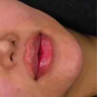 فیلر لب قیمت ویژه وهایفوتخفیف فوق العاده|خدمات آرایشگری و زیبایی|یزد, |دیوار