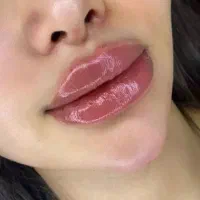 ژل و بوتاکسoff شب یلدا