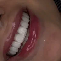 کامپوزیت دندان روکش لمینت با قیمت مناسب و اقساط