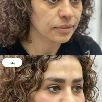 جشنواره ژل توسط پزشک برای شما عزیزان|خدمات زیبایی و سلامت|کرمانشاه, |دیوار
