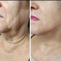 ژل و بوتاکس و مزو ژل|خدمات آرایشگری و زیبایی|بومهن, |دیوار