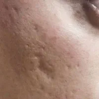 درمان تخصصی در یک جلسه اسکار آکنه و جای جوش|خدمات زیبایی و سلامت|کرمانشاه, |دیوار