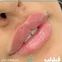 خالبرداری،حذف تاتو با لیزر و تمامی تزریقات زیبایی