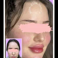 آموزش  و ارائه  ژل و بوتاکس و مزو|خدمات آموزشی|شیراز, سینما سعدی|دیوار