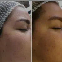 اف ویژه پاکسازی پوست