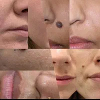 خالبرداری و خال برداری لیزر