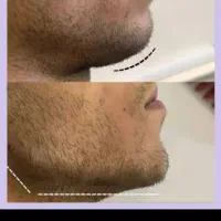 کلینیک تزریق ژل لب روسی فیلر چانه لیزر لیفت صورت|خدمات آرایشگری و زیبایی|تهران, صادقیه|دیوار