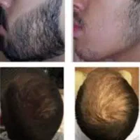 ریز مو و رویش دوباره مو|آرایشی، بهداشتی، درمانی|کرج, شهرک اوج|دیوار