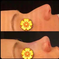 جراحی بینی،رینوپلاستی