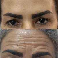 تخفیف یلدایی  بوتاکس و فیلر /ژل  در مطب