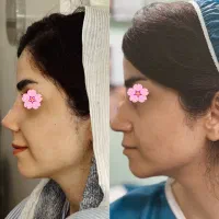 عمل بینی متخصص گوش و حلق و بینی/بدون تامپون