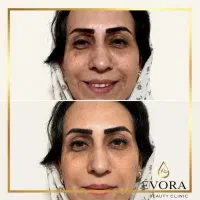 بوتاکس و فیلر اصل با تخفیف ویژه، زیرنظر پزشک|خدمات آرایشگری و زیبایی|ساری, |دیوار