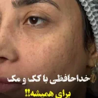 رفع تخصصی کک مک و خال در یک جلسه بدون بازگشت/هایفو