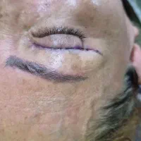 بلفاروپلاستی، جراحی  پلک، لیفت صورت،لیپو