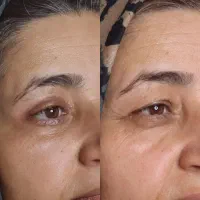 خدمات زیبایی پلاسما جت پلکسر تراپی صورت وفشیال
