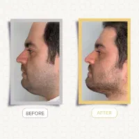 ساکشن غبغب|خدمات آرایشگری و زیبایی|رشت, گلسار|دیوار