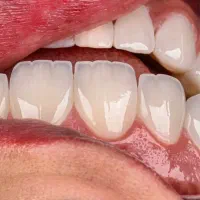 کامپوزیت دندان روش لیرینگ با ضمانت|خدمات آرایشگری و زیبایی|مشهد, فلسطین|دیوار