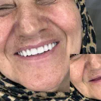 دندان مصنوعی فقط 7.800 به دلیل جشنوار عیدانه