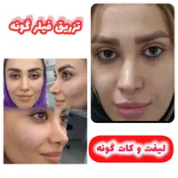 ژل بوتاکس ۳۹۰/ فیلربینی زیرچشم/لیفت صورت شقیقه/نخ|خدمات آرایشگری و زیبایی|تهران, فدک|دیوار
