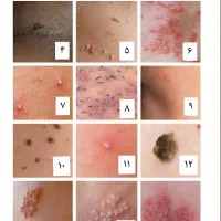 زگیلhpv