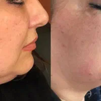 اندولیفت/ جوانسازی /تخلیه چربی صورت / رفع سلولیت|خدمات آرایشگری و زیبایی|تهران, صادقیه|دیوار