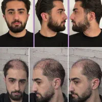 قطع ریزش مو در «هفت»روز