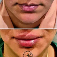 بوتاکس ، فیلر ،ژل ،مزو با تخفیفات ویژه|خدمات زیبایی و سلامت|تبریز, |دیوار