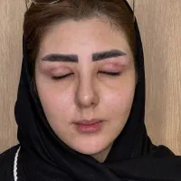 تزریق ژل بوتاکس هایفوتراپی بلفاروپلاستی توسط پزشک|خدمات آرایشگری و زیبایی|تبریز, |دیوار