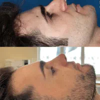 جشنواره جراحی زیبایی بینی (عمل بینی)