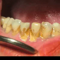 تخفیف ویژه جرمگیری تا ۱۵ آذر فقط ۱۸۰۰