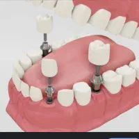 دندانپزشکی اقساطی|خدمات آرایشگری و زیبایی|قم, پردیسان|دیوار
