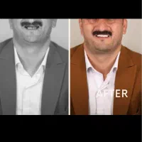 ایمپلنت دیجیتال یک روزه