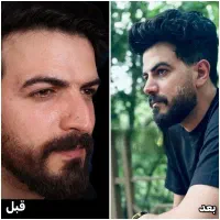 کانال روبیکا و بله/نمونه عمل دکتر غنی‌زاده/ارومیه