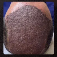 کاشتمو با تراکم بالا باضمانت۱۰ساله بدون ریزش