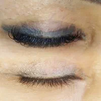 ریموو(پاک کردن)تتو