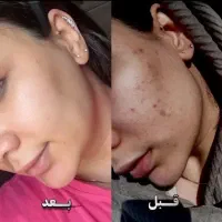 کرم بیوممتیک اصل(بهترین جایگزین بوتاکس)+هدایا ویژه