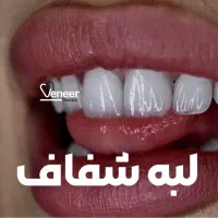 دندانپزشکی لمینت الهیه منطقه ۱ کامپوزیت سرامیکی