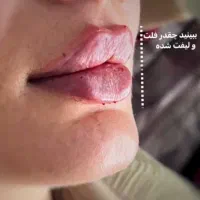 تزریق ژل و بوتاکس توسط پیرا پزشک مجرب|خدمات آرایشگری و زیبایی|اهواز, پادادشهر|دیوار
