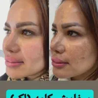 کرم ضدلک لاکچری کوین اصل نمایندگی کوثر|آرایشی، بهداشتی، درمانی|کوثر, |دیوار